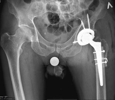 Коксартроз тазобедренного сустава 3. Диспластический коксартроз тазобедренного сустава. Диспластический коксартроз тазобедренного сустава 3. Коксартроз тазобедренного сустава 2 степени. Коксартроз 2-3 степени тазобедренного.